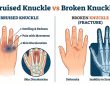 bruised knuckle vs broken knuckle