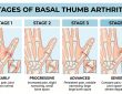 stages of basal thumb arthritis