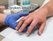 What Does a Broken Knuckle Look Like