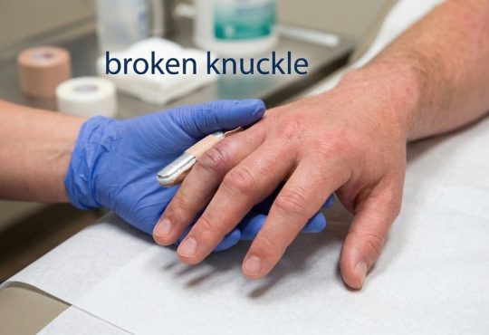 What Does a Broken Knuckle Look Like