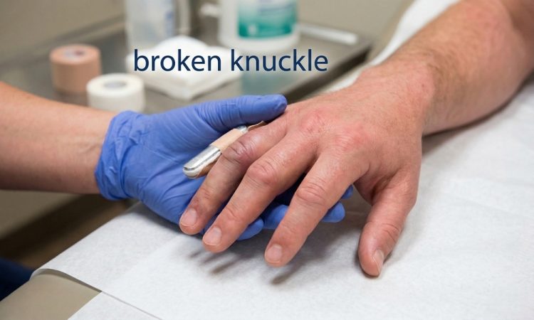 What Does a Broken Knuckle Look Like