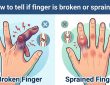 how to tell if finger is broken or sprained