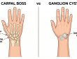 carpal boss vs ganglion cyst